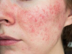 Como acabar com a acne de uma vez por todas?